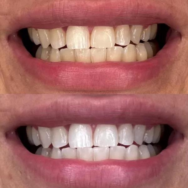 KIT BLANCHIMENT DENTAIRE ICEPEARL